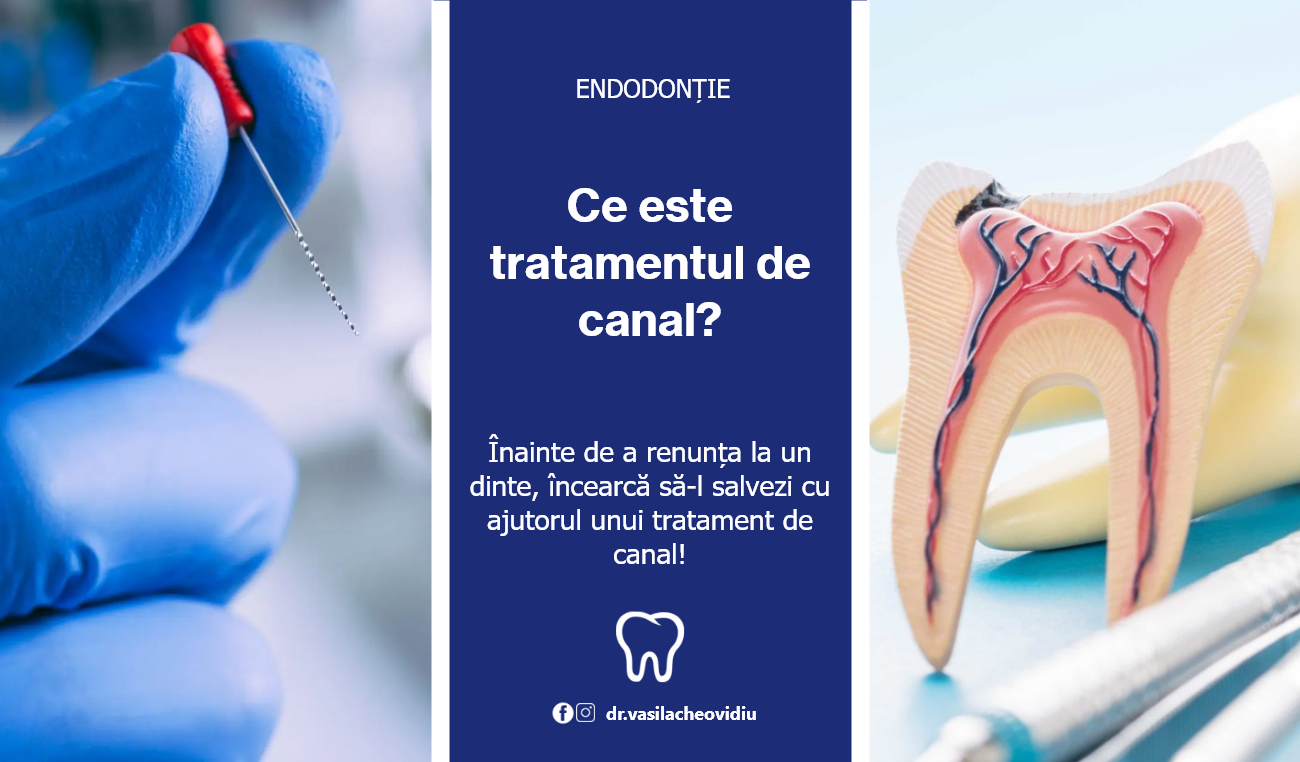 tratament de canal endodontie endodont ploiesti