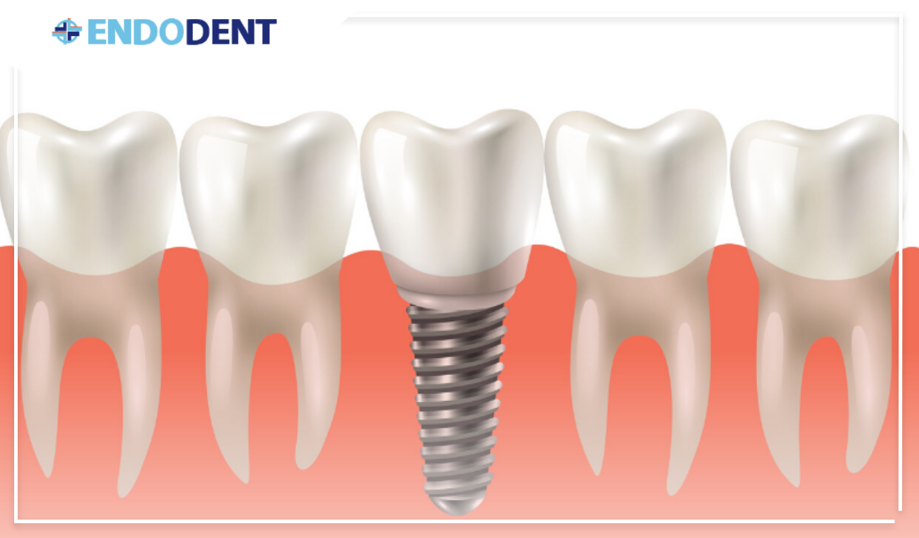 implant dentar ploiesti vs punte dentara ploiesti